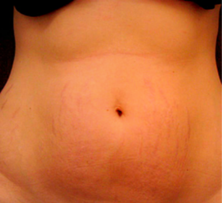 1690277061_After  stretch marks reduction.png
